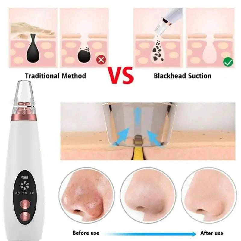 USB Rechargeable Blackhead Remover Vacuum effective suction comparison and skin improvement results.