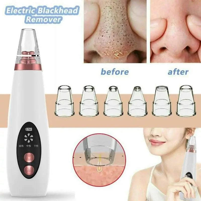 USB Rechargeable Blackhead Remover Vacuum with multiple suction levels and before-after skin results.